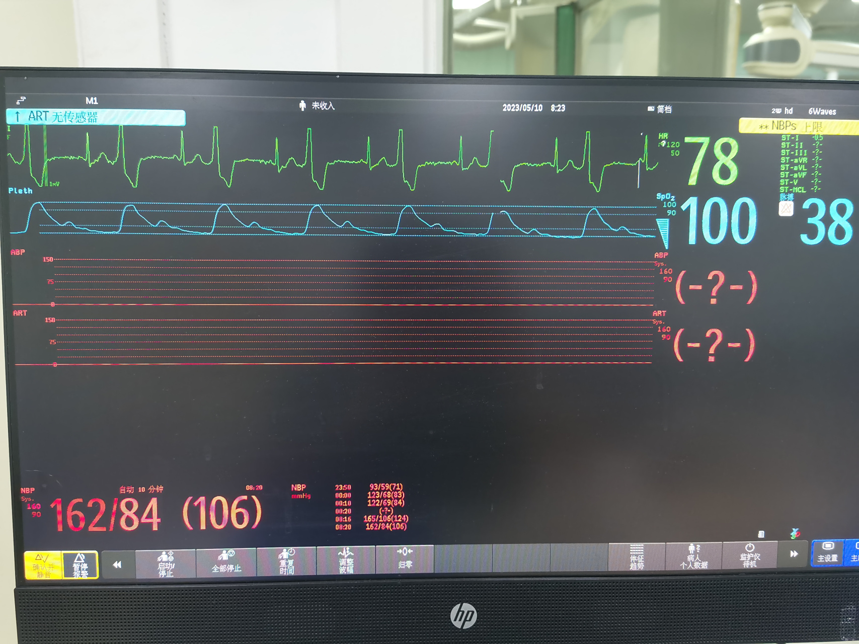 心电小知识:监护示室早二联律,宽的为室性早搏