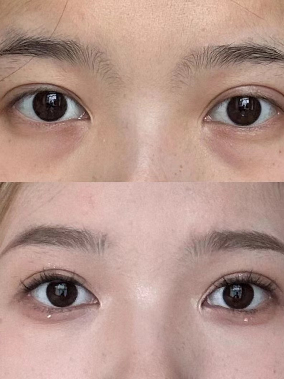 去眼袋手术前后对比照  爱美的朋友都知道,这脸上一旦出现眼袋,整个人