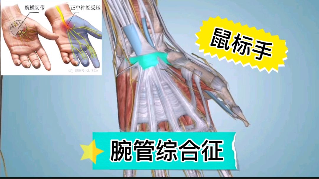 腕管综合征,鼠标手解剖分析