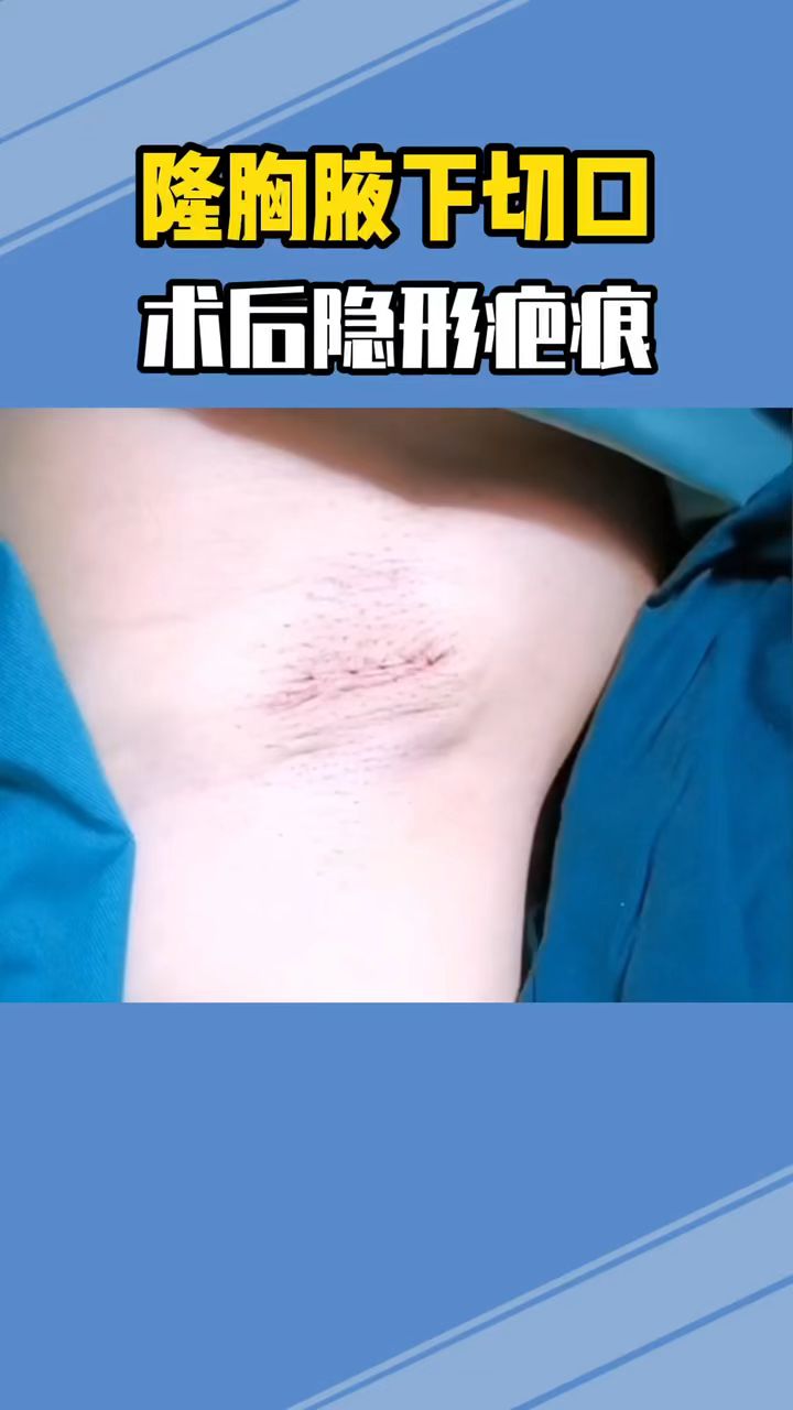 真实下皱襞切口展示你觉得切口明显吗