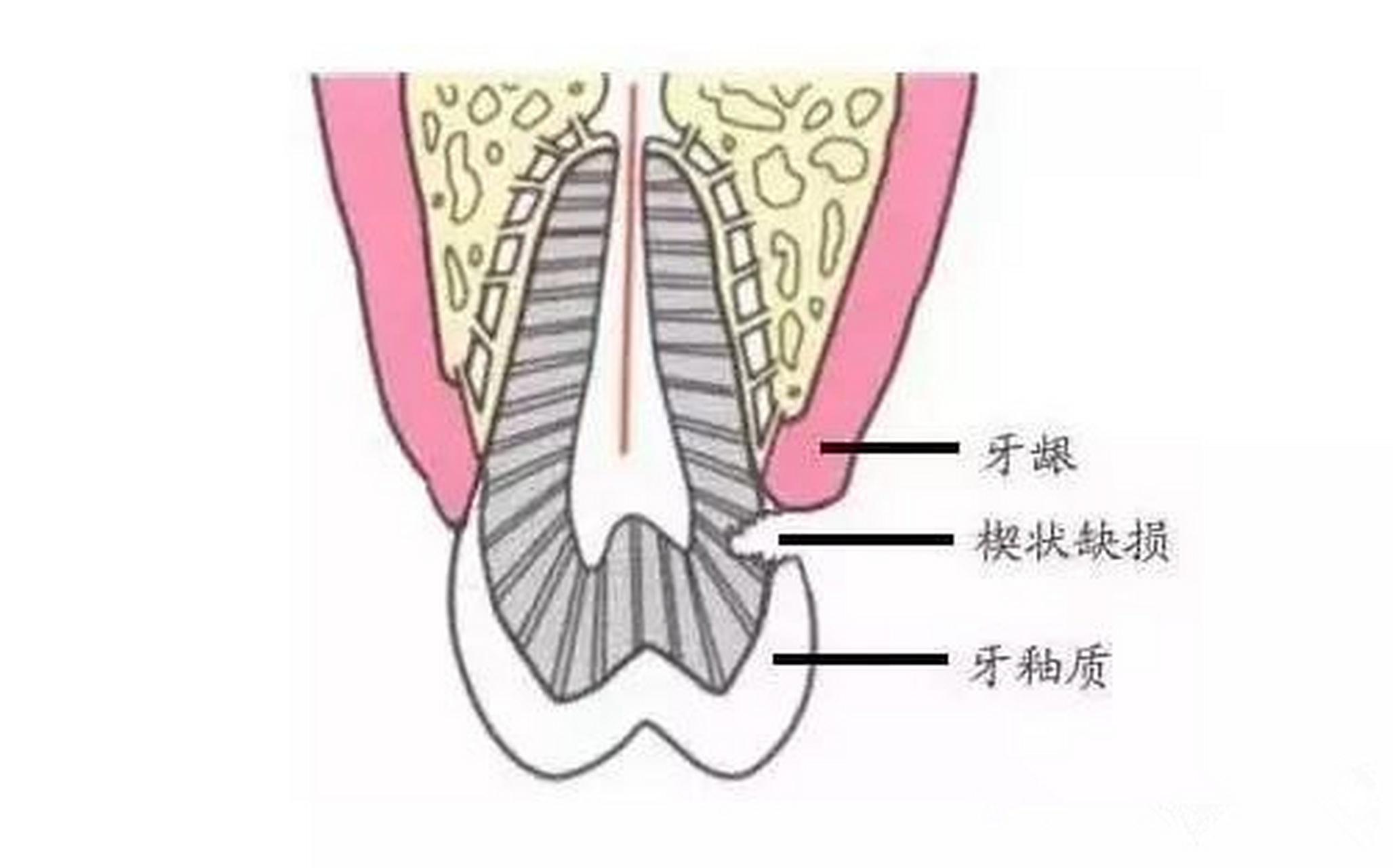 楔状齿鞍鼻图片