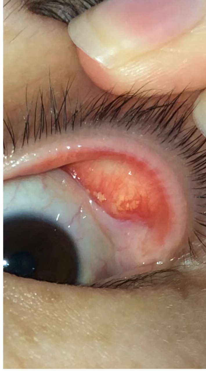 谁知道这是什么,好吓人 今天早上起来突然觉得眼睛进东西了,扒开看看