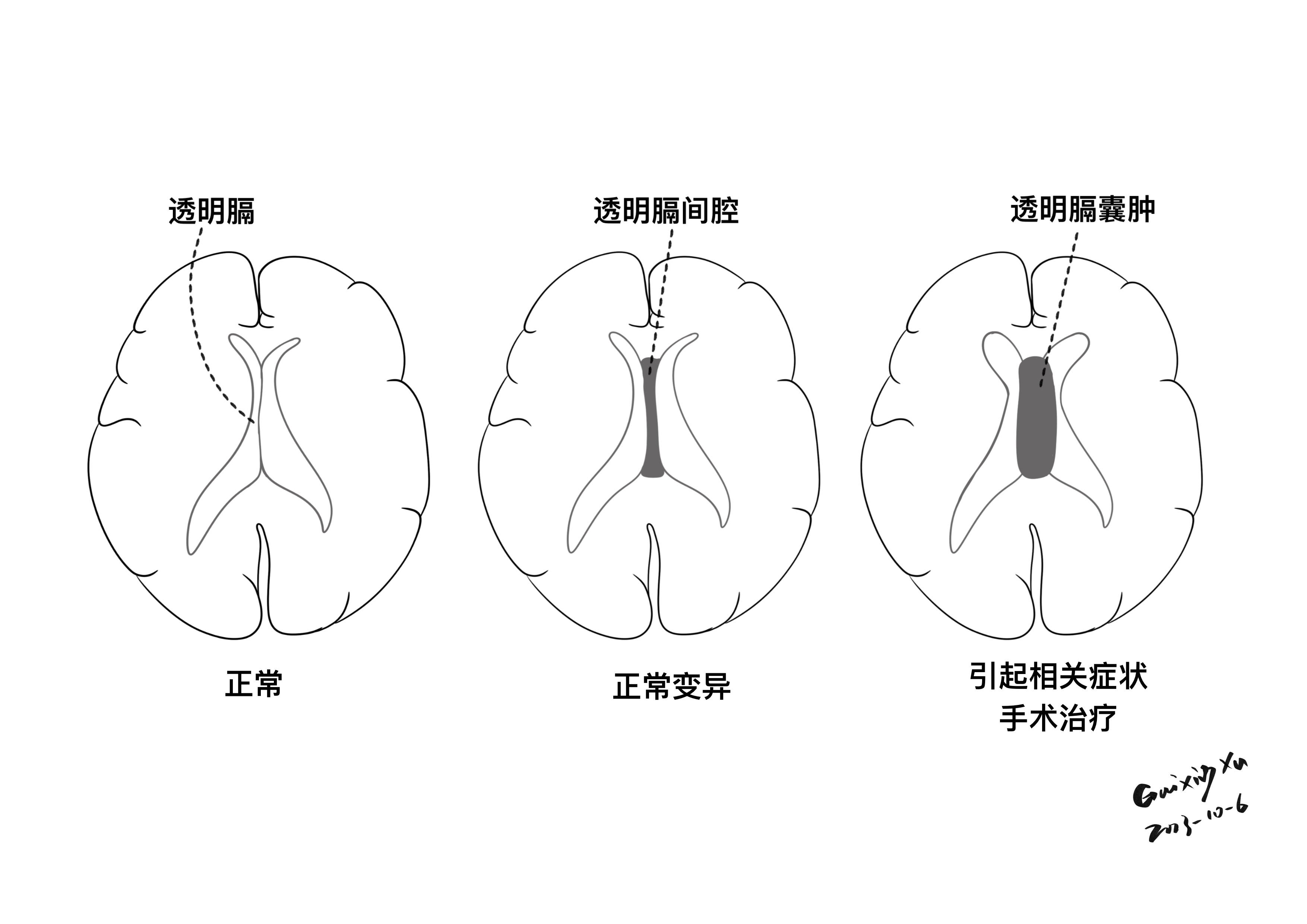 透明隔间腔透明隔腔脑透明隔在哪里透明隔间腔在脑什么位置透明隔缺失