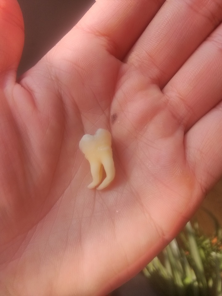 如果你的智齿萌出位置良好,没有对其他牙齿产生影响,那么一般情况下