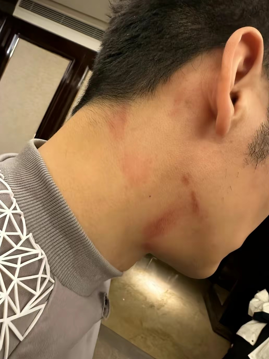 李晨脖子受伤被当成吻痕,工作室澄清:擦伤,求放过