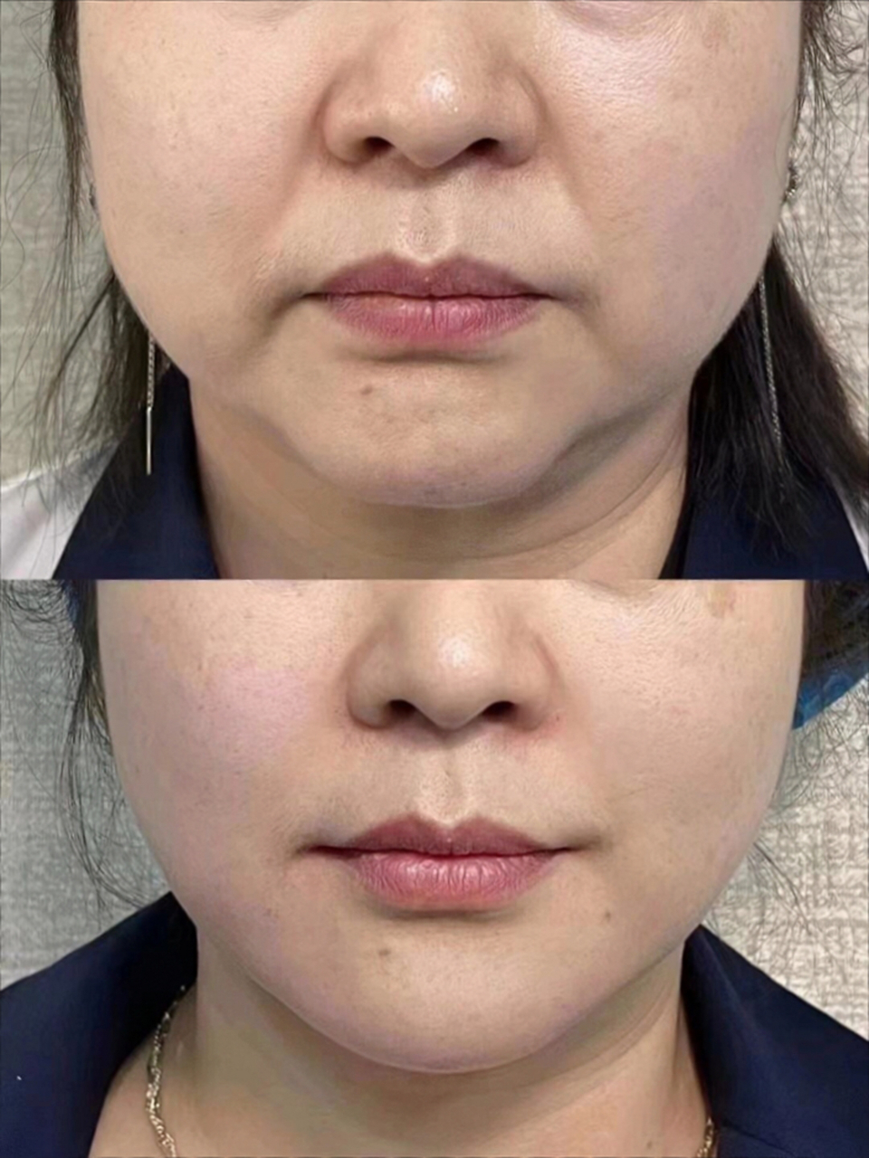 苹果肌下垂移位,口角囊袋凸出,你只需要做筋膜提升  这两个求美者都是