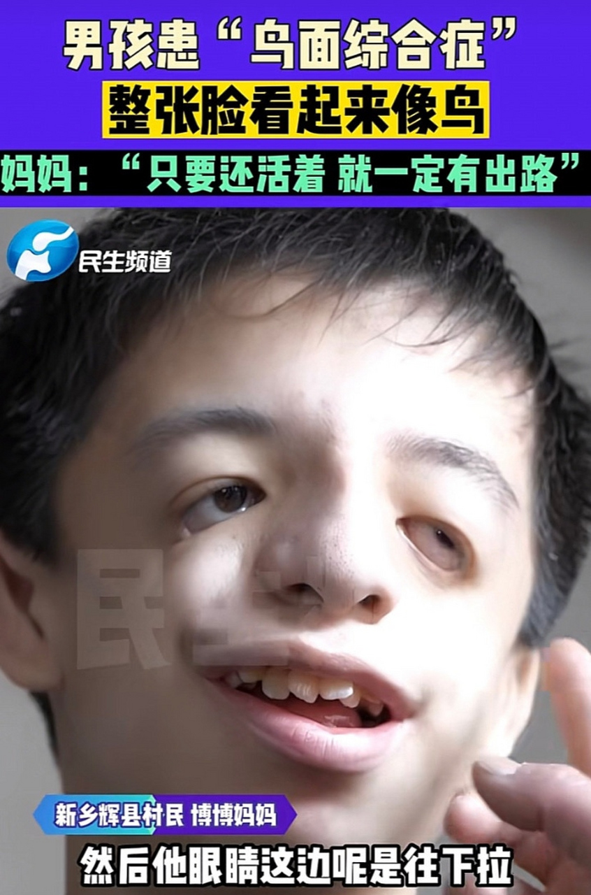 15岁的男孩,患有"鸟面综合症",不仅整张脸畸形生长呈现出可怕的样子
