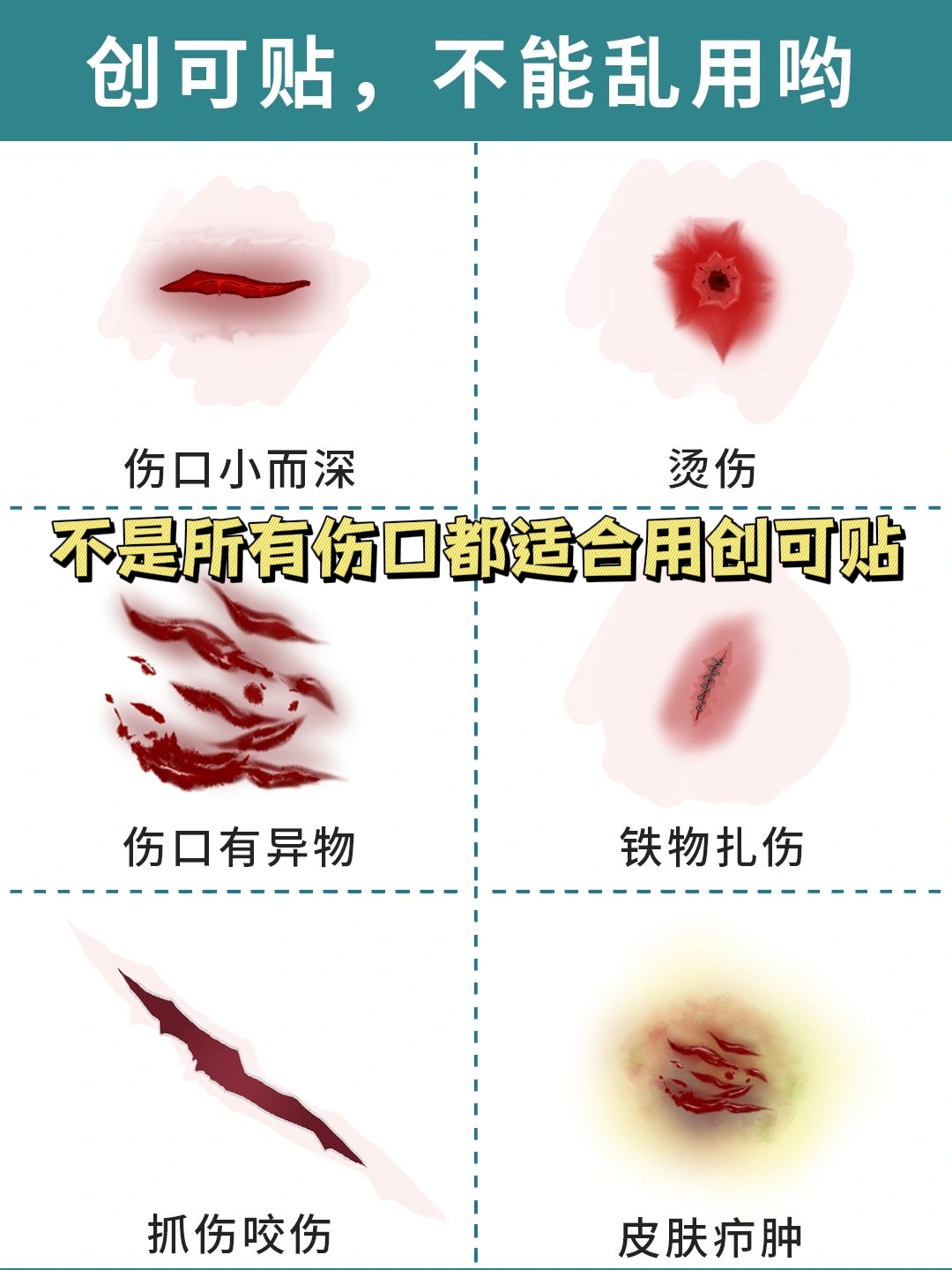 伤口小而深:这种伤口不容易清洗干净,容易导致感染或者破伤风. 2