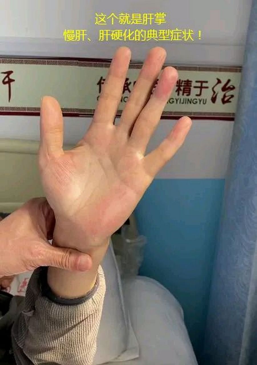 个就是肝掌,典型的肝掌.