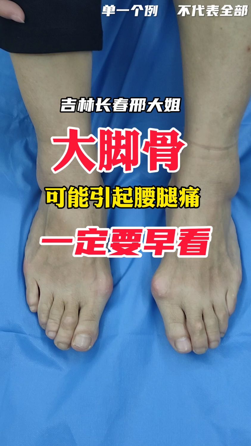 大脚骨,可能引起腰腿疼,一定要早看!