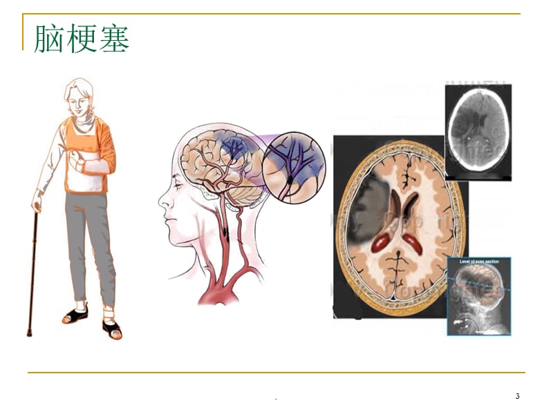 脑梗动画图片