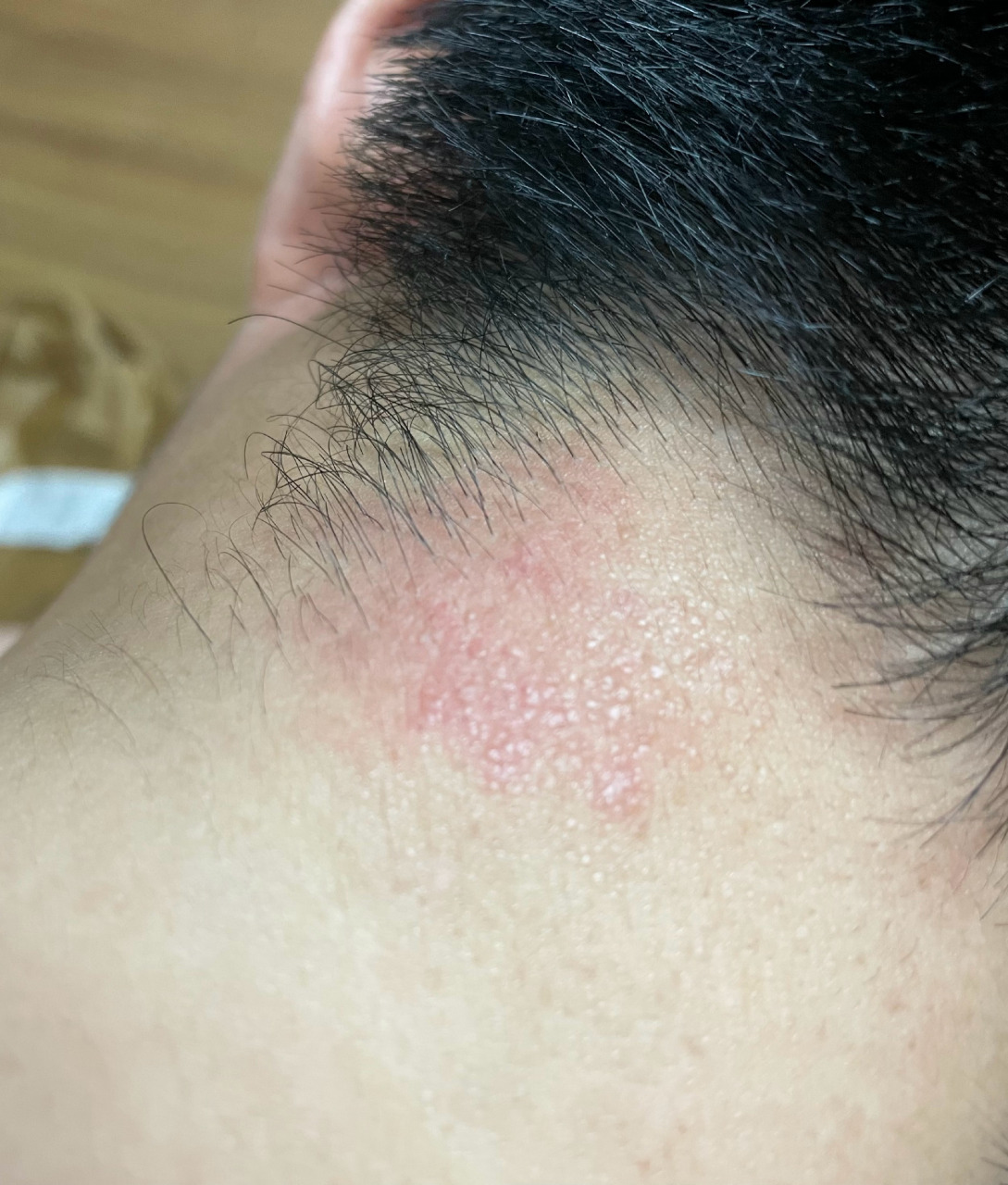 前段时间压力大,睡眠也不好,脖子的神经性皮炎犯了,总是自觉不自觉的