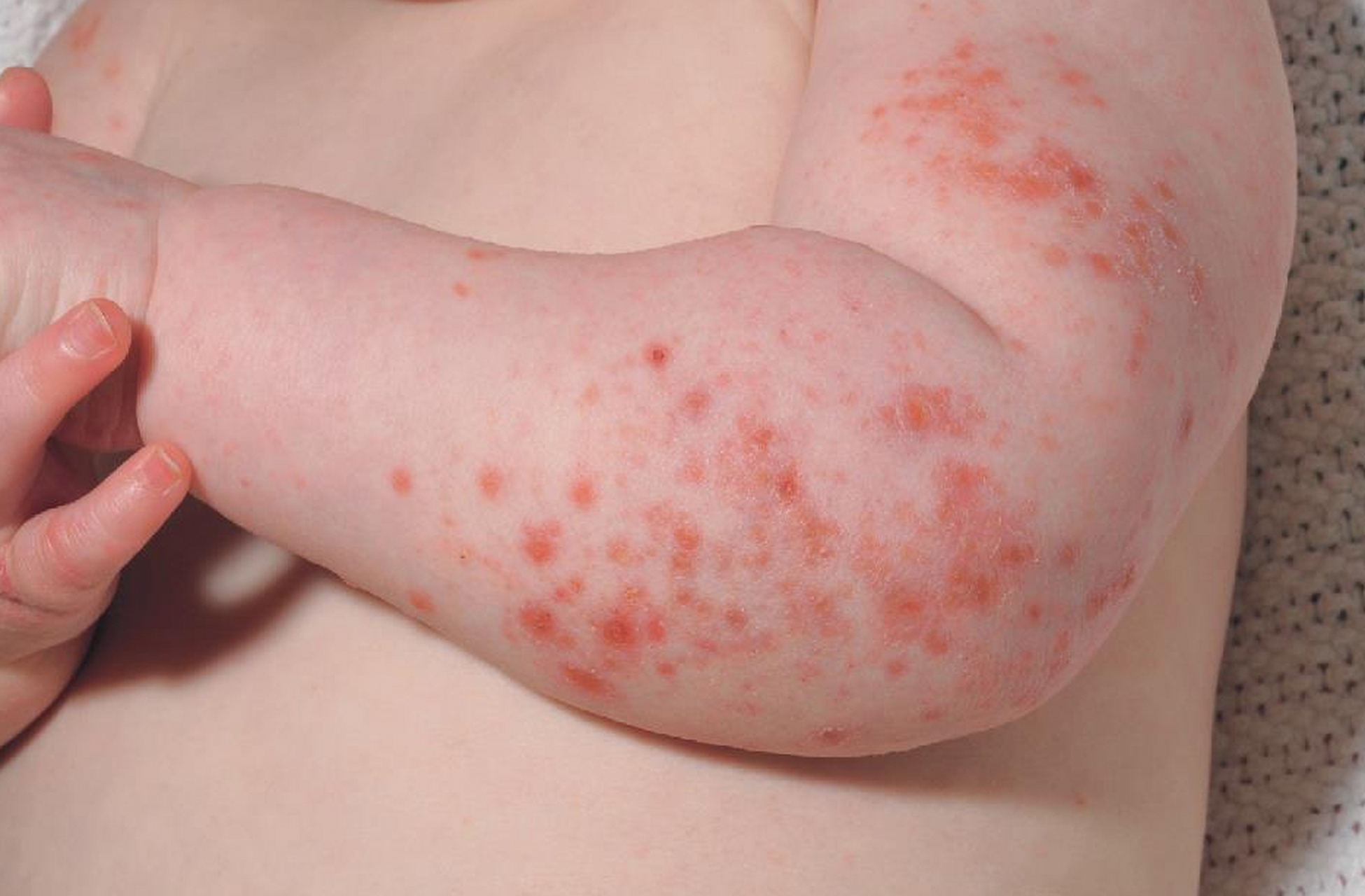 湿疹也叫特应性皮炎,主要与遗传,环境,皮肤屏障功能受损,特应性淌质