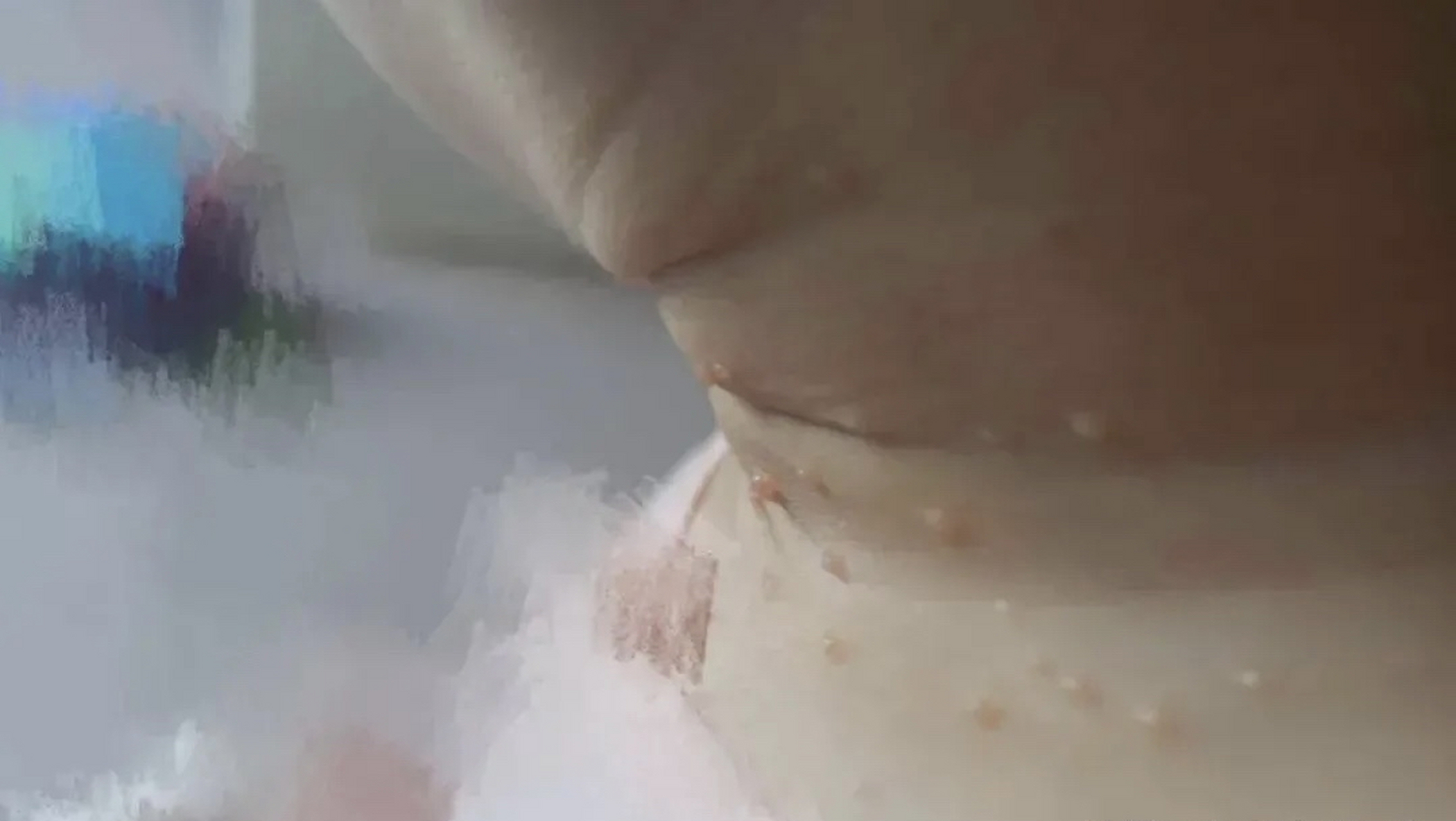 今天看了一个小女孩,自诉外阴处长了类似水痘的疙瘩,是接触男朋友后才