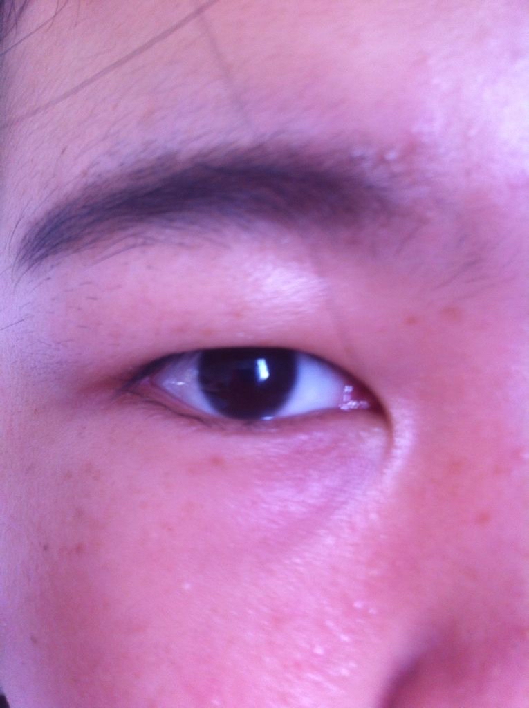 肿眼泡抽脂手术是通过在上眼皮合适的