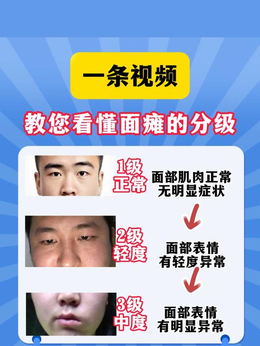 一条视频教您看懂面瘫的分级!