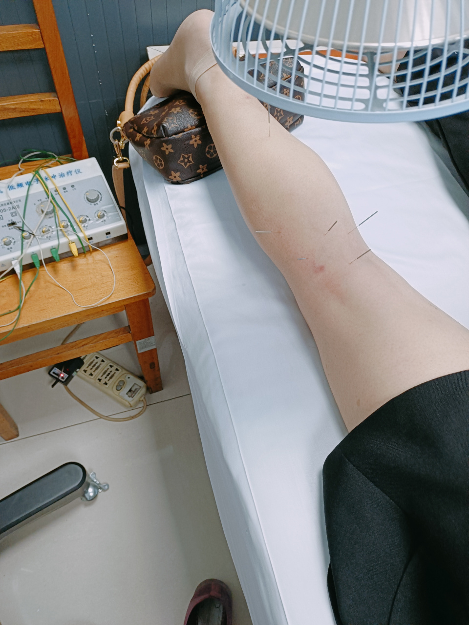 妈妈腿疼几天了,今天带去三甲医院中医门诊,做了针灸.