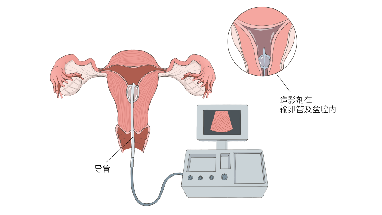 输卵管插管图片