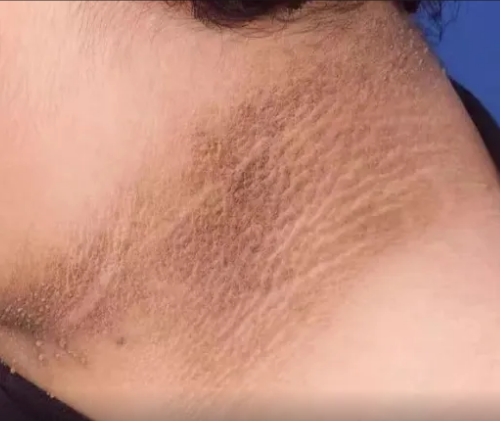 脖子黑黑的洗不掉,可能不是脏,而是患上了黑棘皮病!