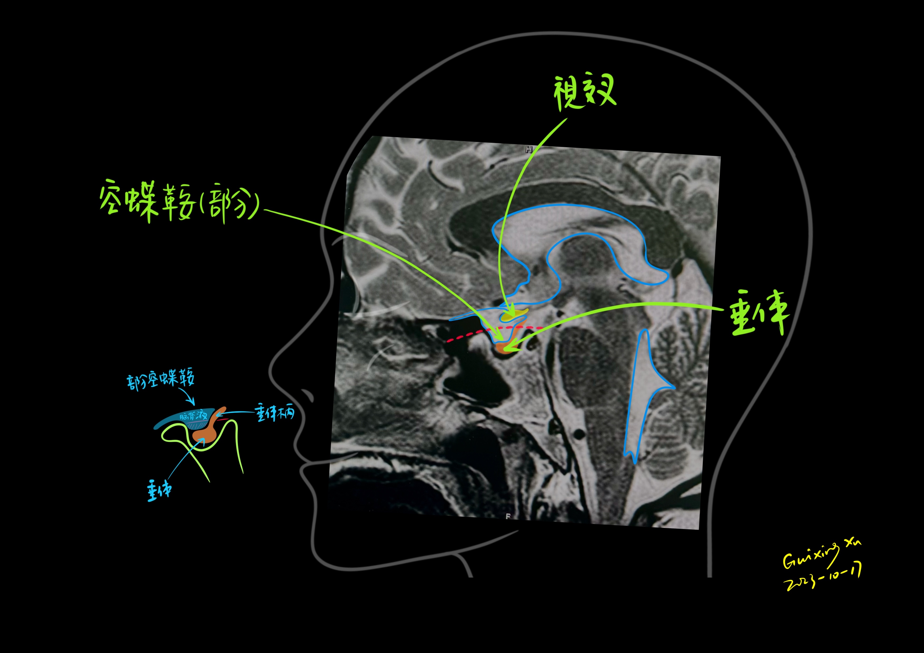 手绘:部分空蝶鞍 空蝶鞍是头痛,外伤,或体检时,常遇到的问题 这个问题