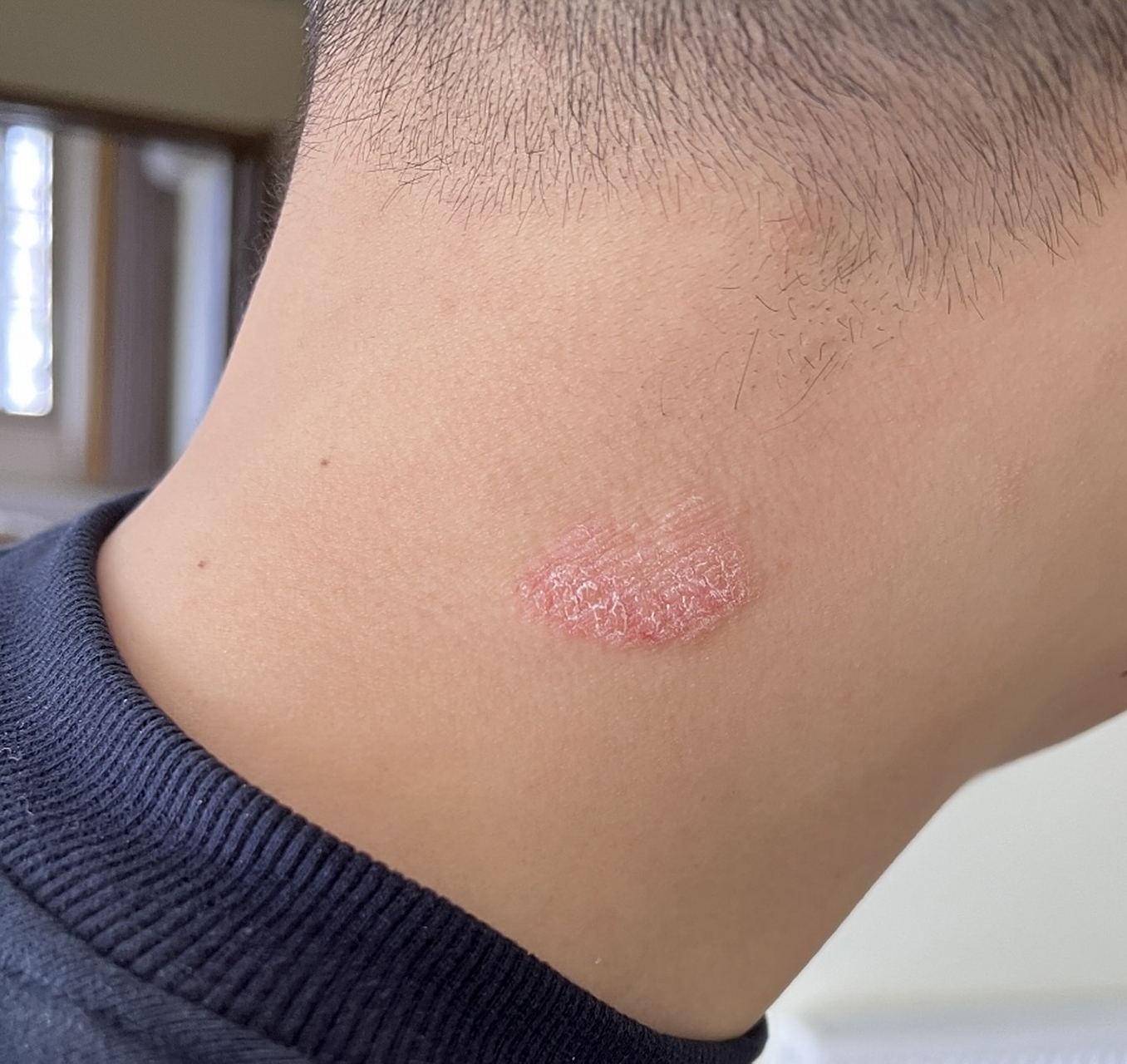 得了神经性皮炎该怎么办?