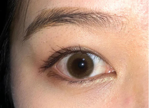 眼白发黄布满血丝是什么原因?