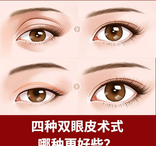 双眼皮能让人看起来更好看?为什么有些人是内双呢,建议阅读这篇