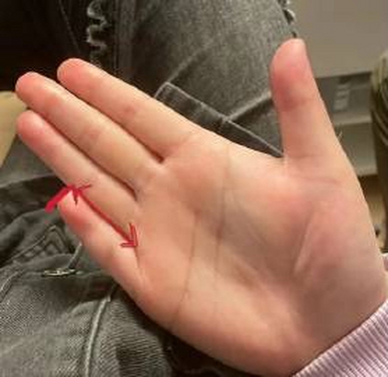 短指症# 短指症是怎么一回事呢?有了解的朋友可以说说嘛.困惑了好久