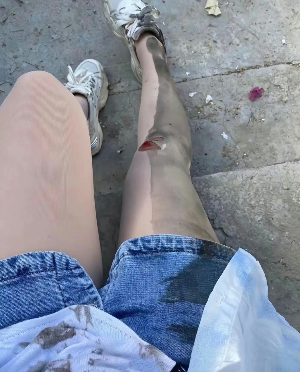 女朋友骑车摔成这个样子,心疼死了.