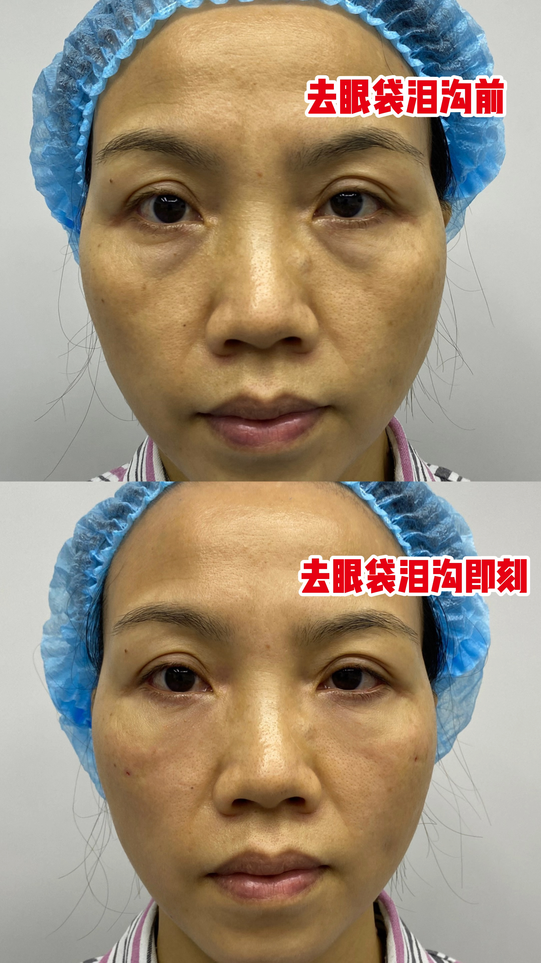 45岁女士做完微创去眼袋 泪沟填充,术后即刻很"惊艳",像变了个人,不敢