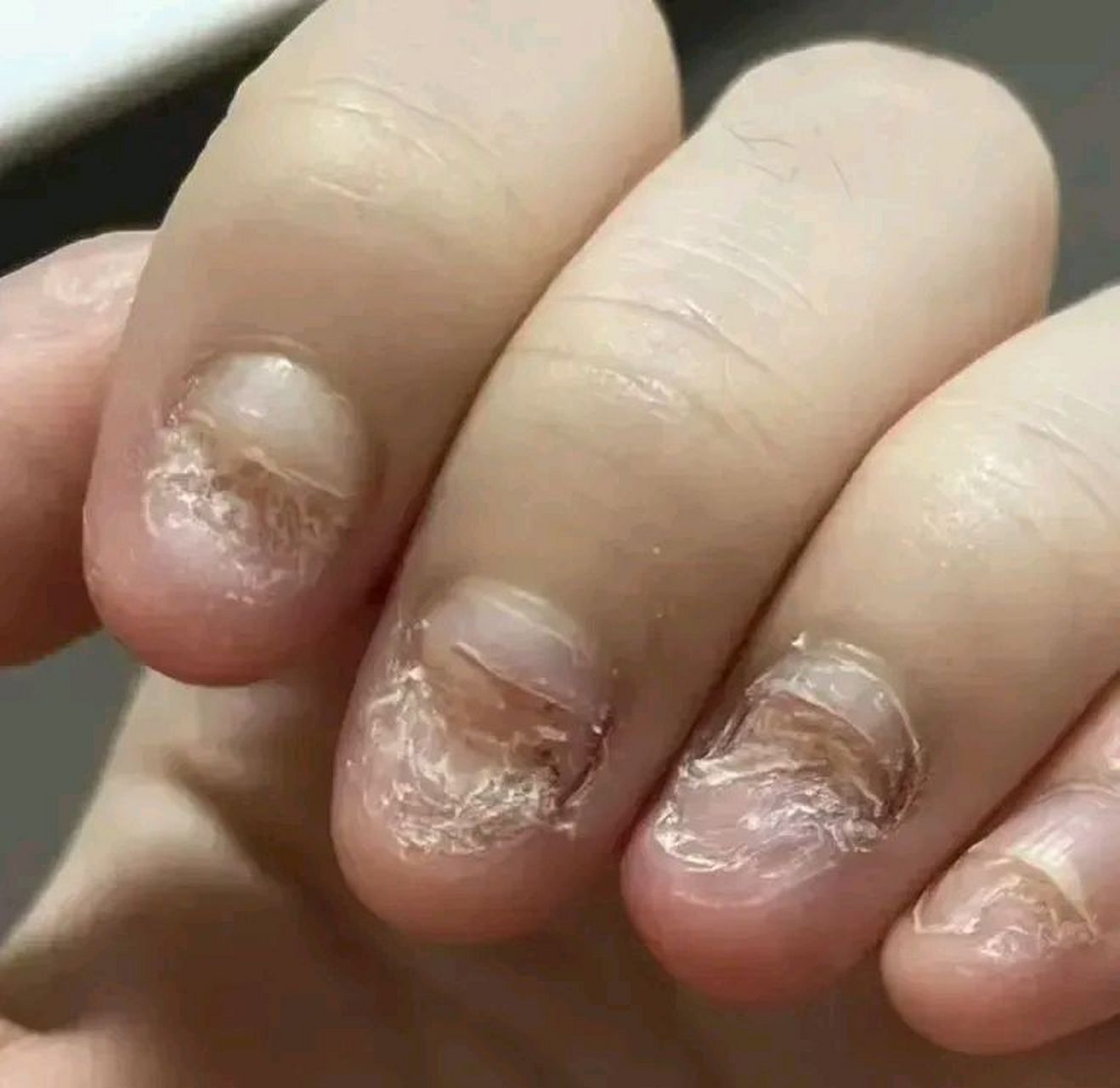 总是忍不住咬指甲怎么办?