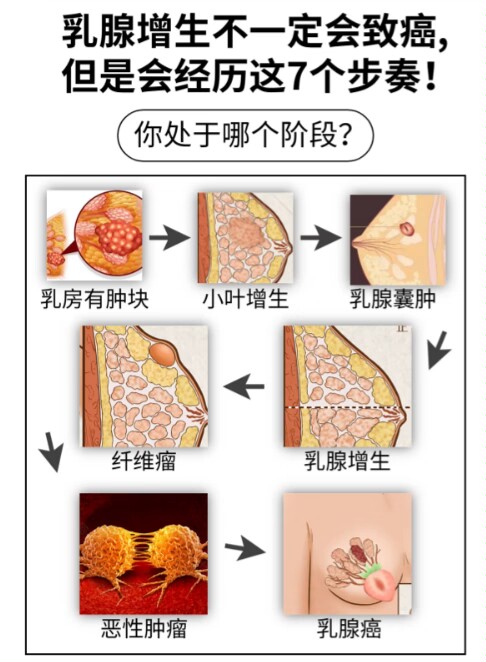 重度乳腺增生图片