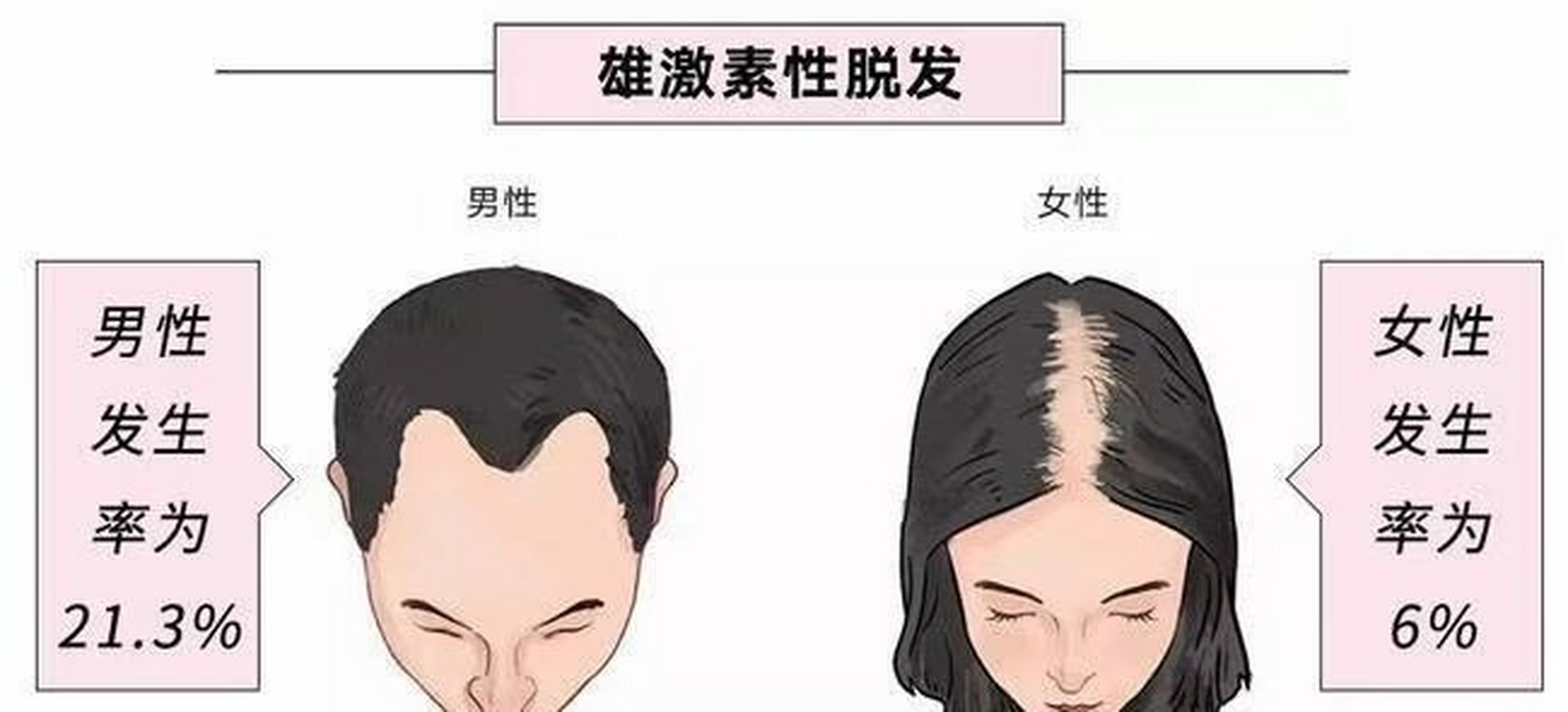 全面了解什么是雄性激素脱发 雄激素性脱发是什么意思?
