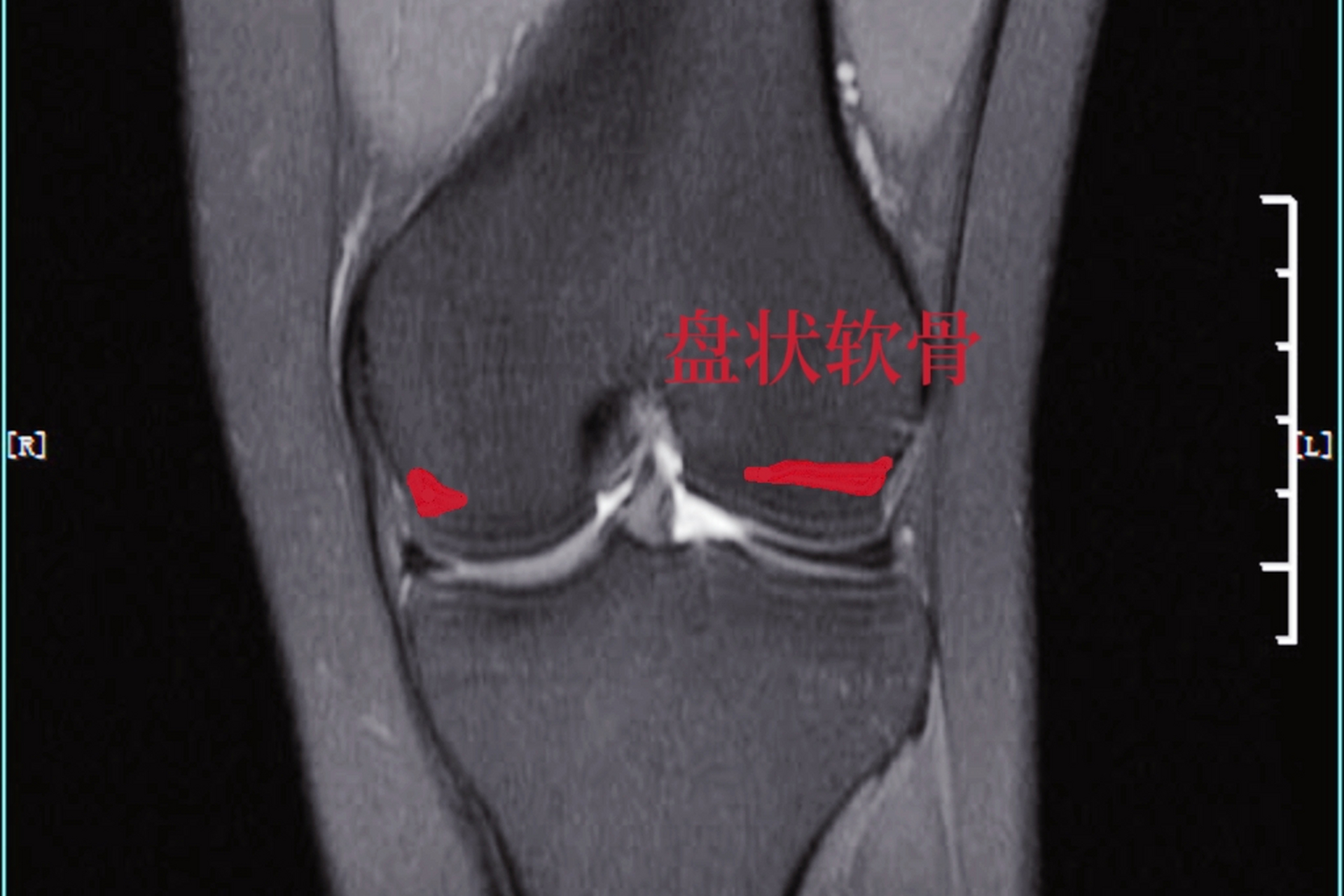 在解剖结构上半月板外缘比较高,内缘相对比较锐利,所以在磁共振影像上