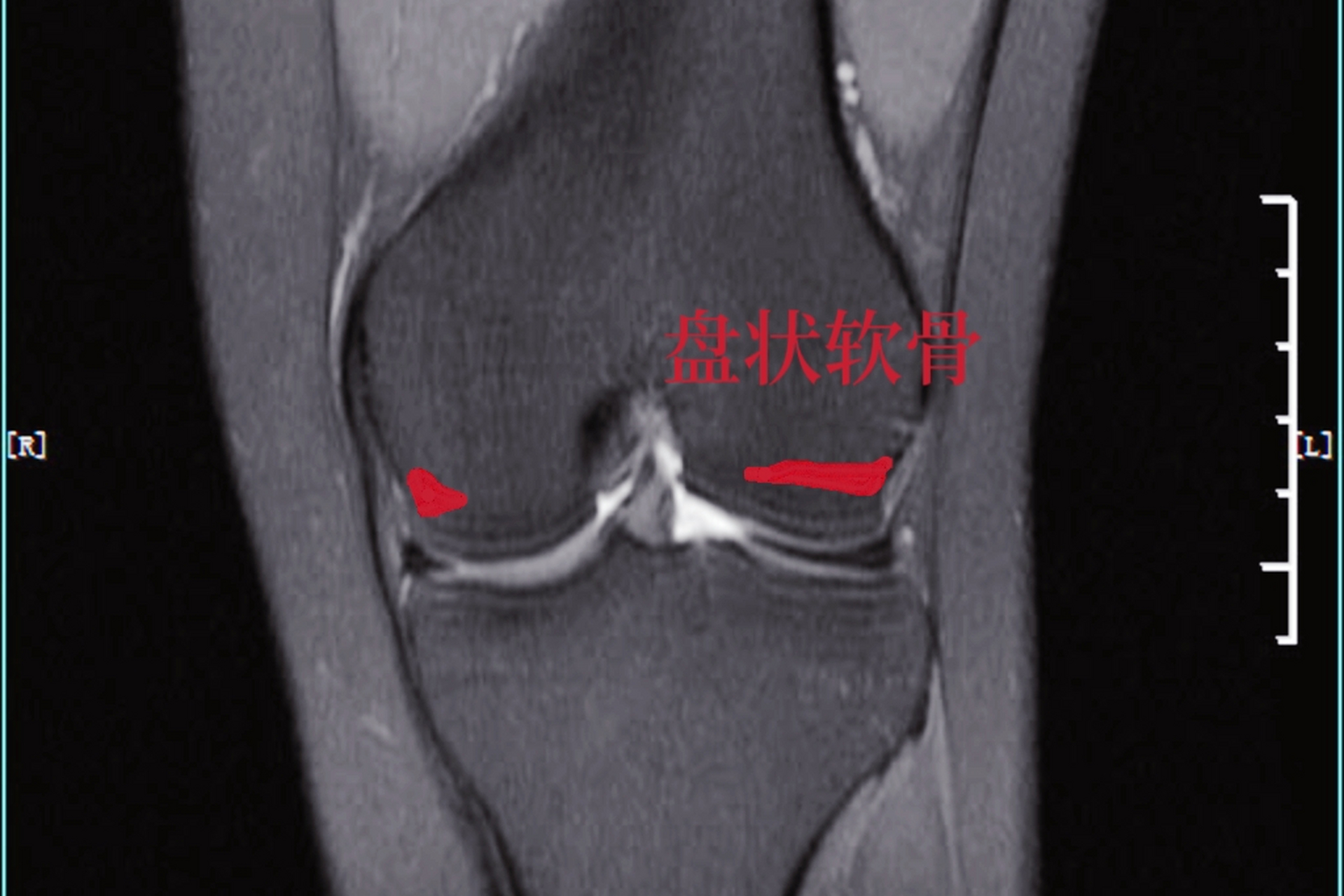 半月板正常核磁图图片