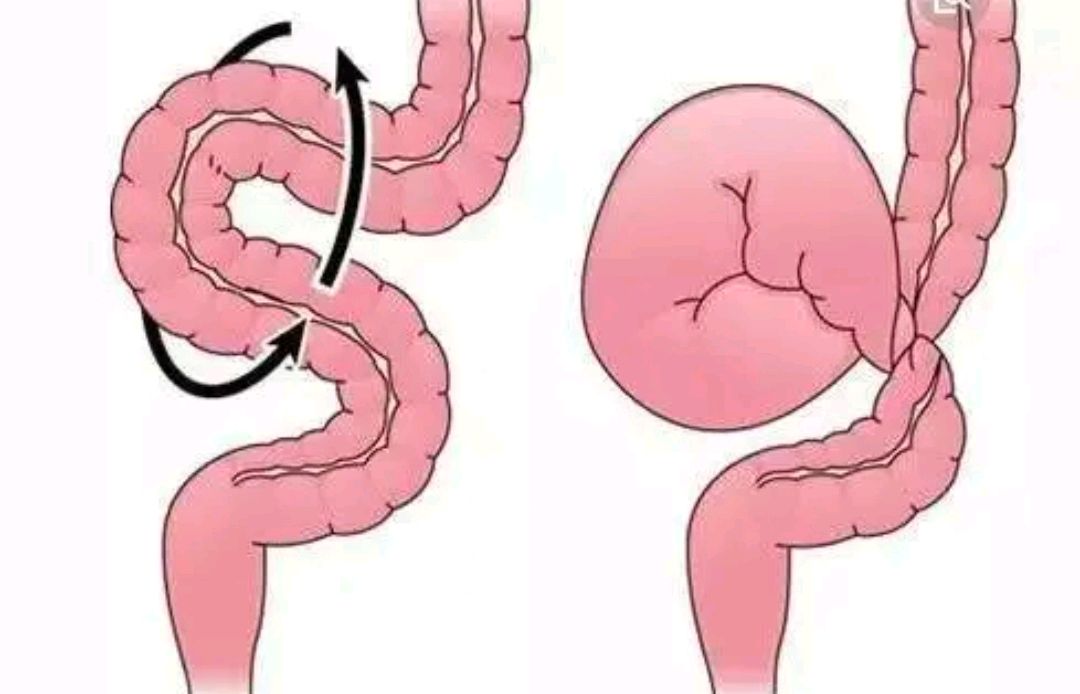 只因男孩饭后做了这个动作,一肚子小肠全变黑,家长要当心