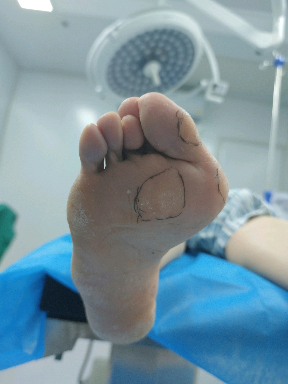 看看你的脚底,有没有茧子? 拇趾外翻的朋友,前足足横弓塌陷,容易出现