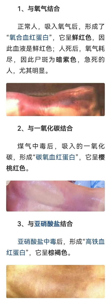 不同死因的尸体,尸斑颜色不一样.直接上图,看看就明白了.