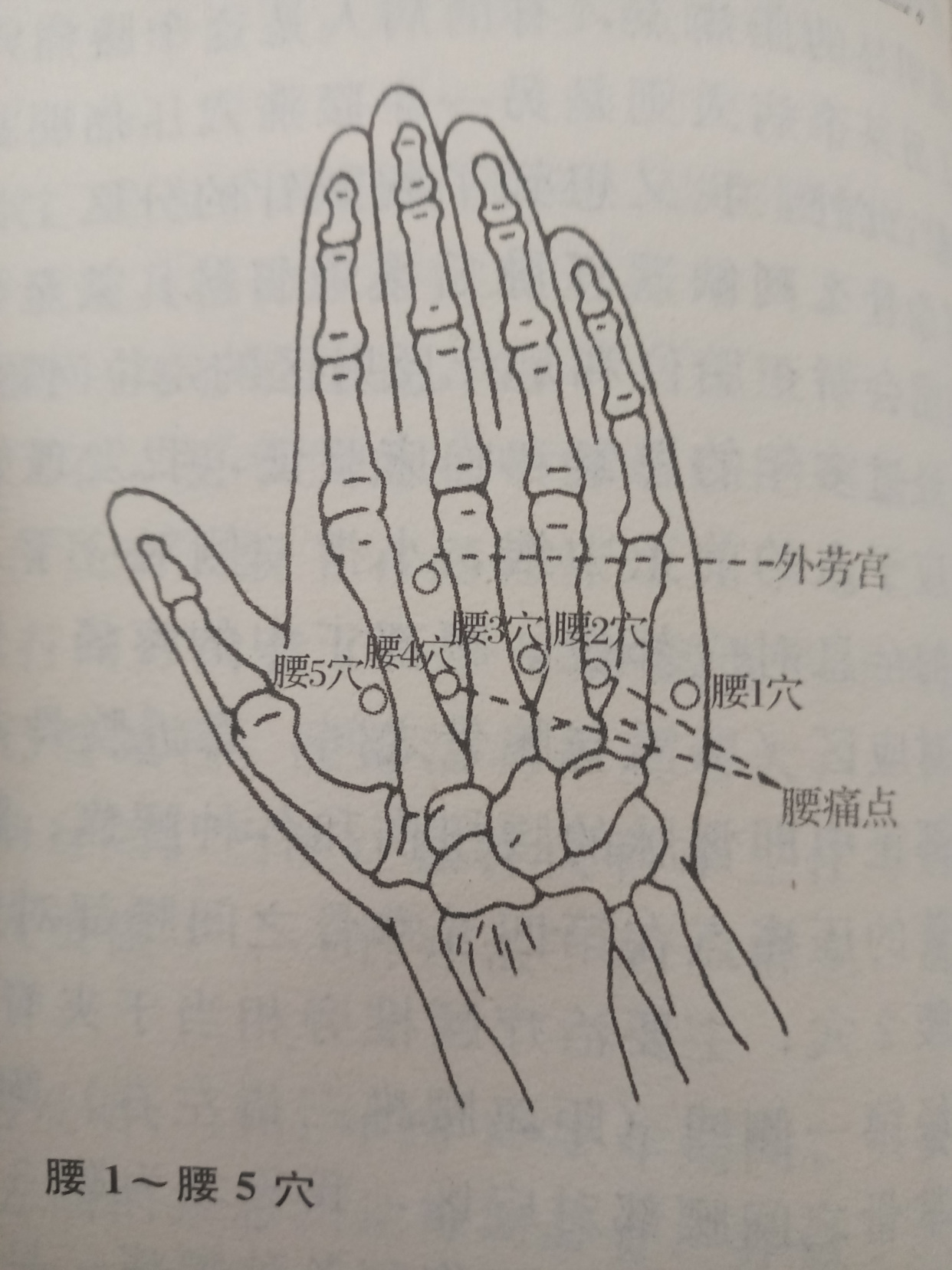 急性腰痛针灸方法