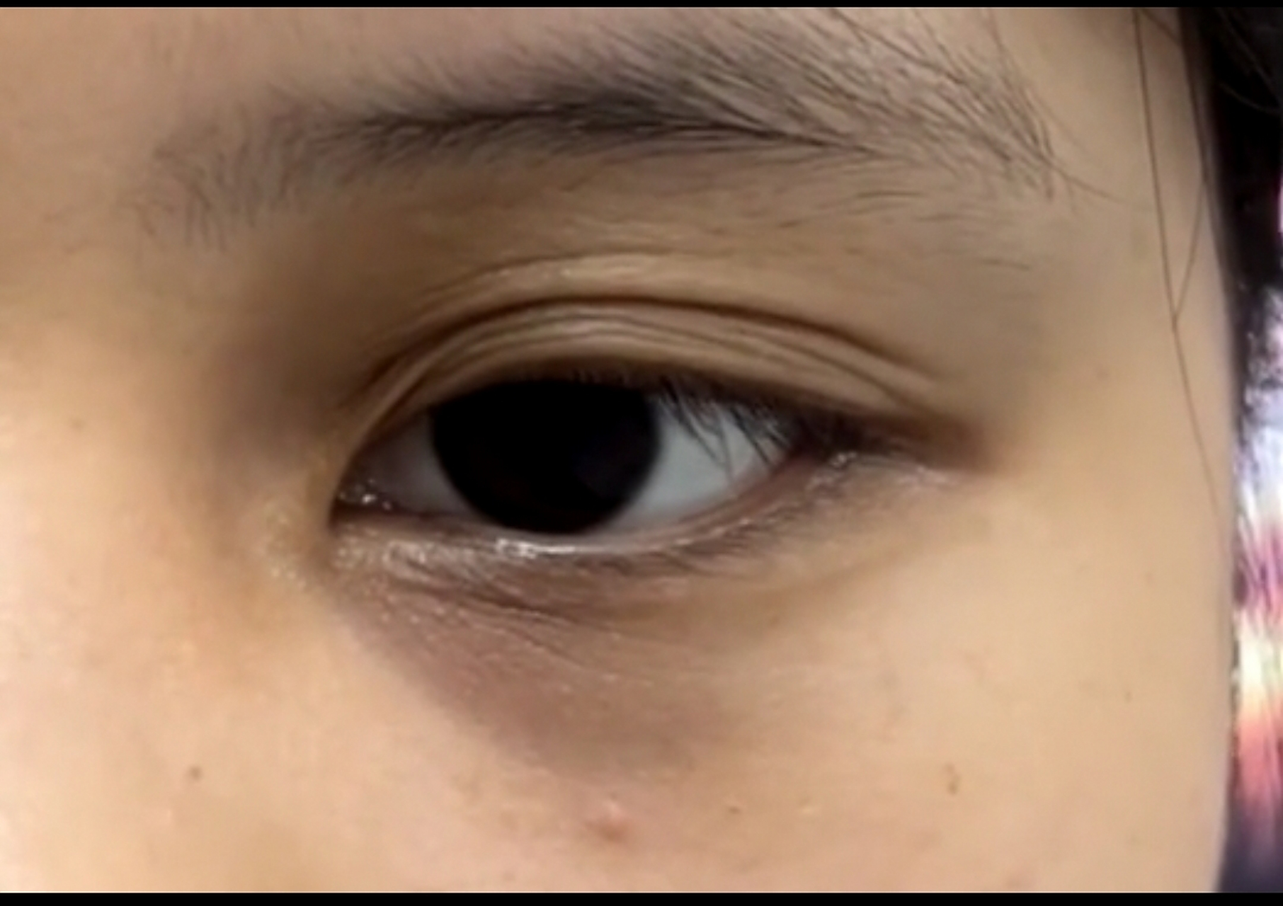 这三种是典型的肝病面容: 1,眼圈发黑 2,巩膜发黄 3,面色蜡黄 如果你