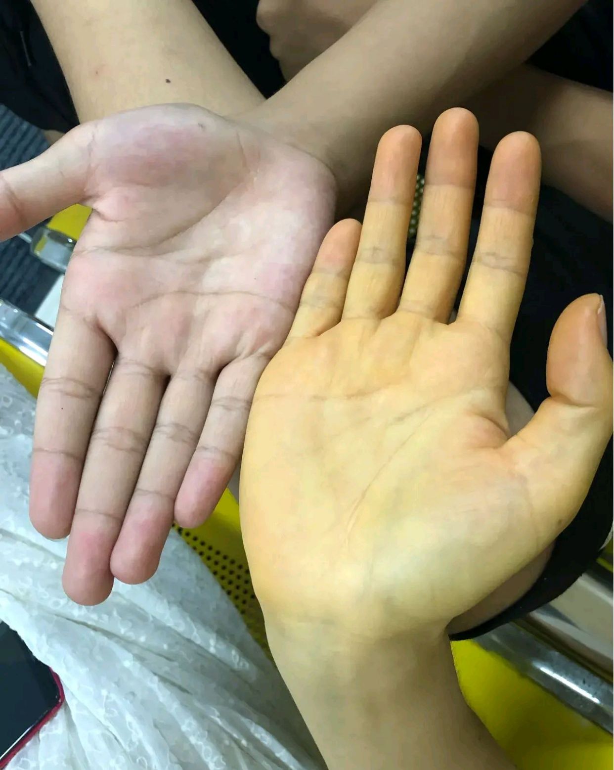 不比不知道,一比吓一跳,手黄是什么原因?