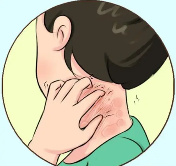 得了湿疹不能洗澡?