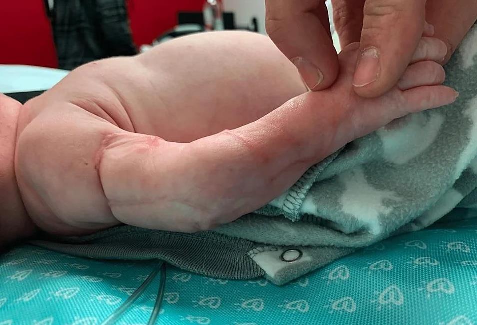 29 周宝宝,患有羊膜带综合症,一只手被收缩带束缚,出现缺血坏死