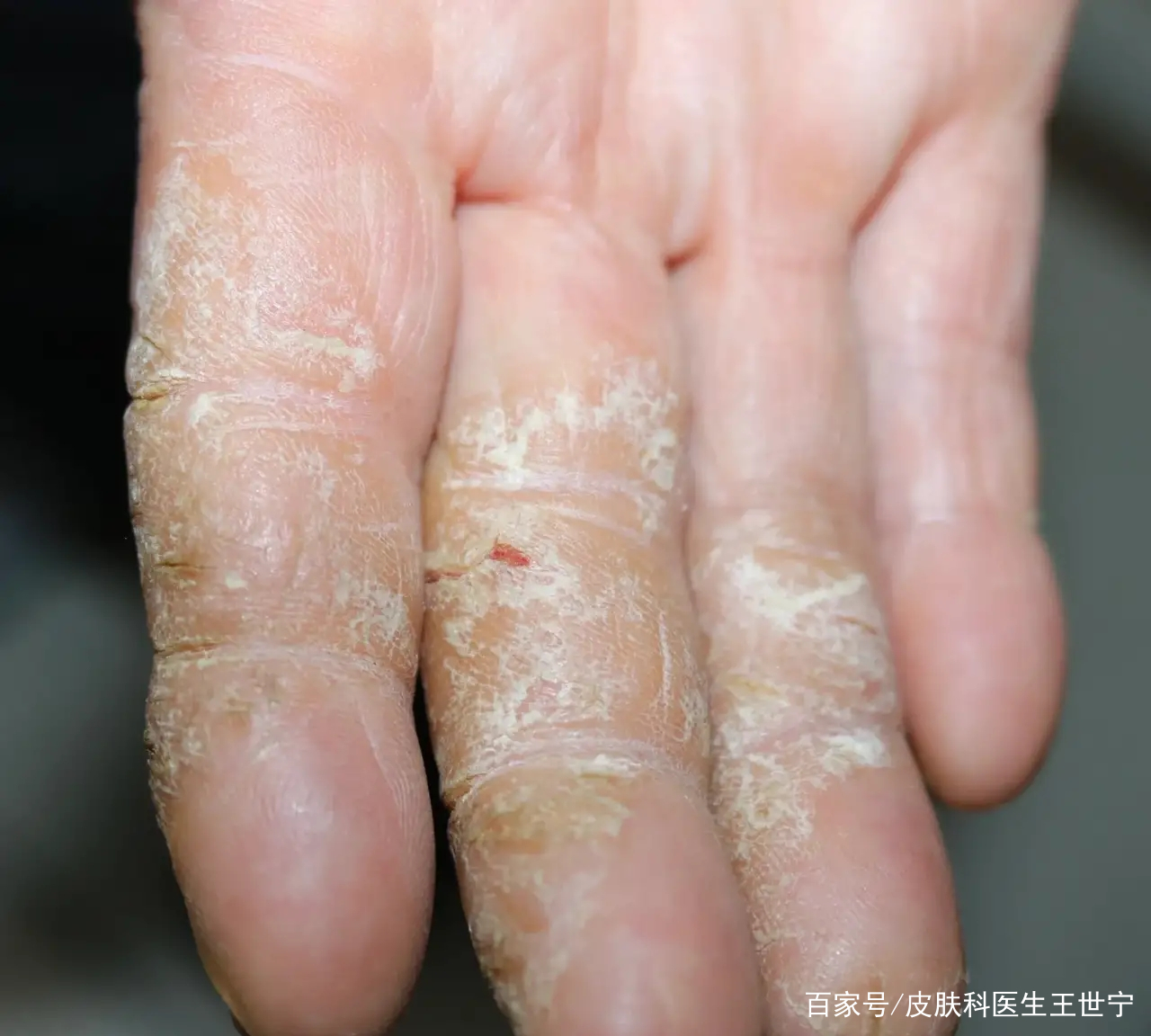 皮肤鸡皮跟干裂起硬皮（突然一块皮肤起鸡皮干燥脱皮）