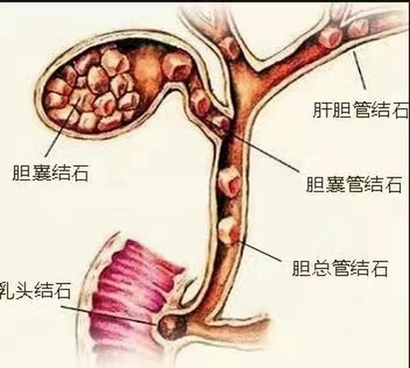 胆结石位置图图片