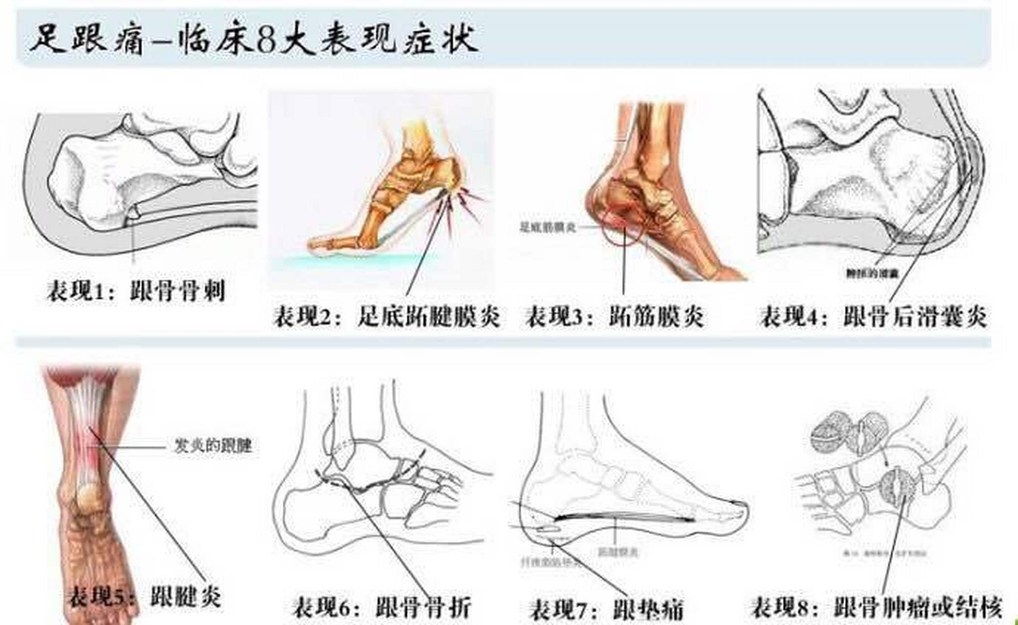 脚部结构脚后跟图片