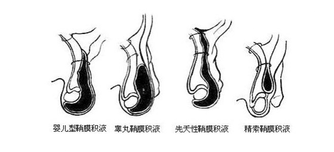 小孩睾丸一大一小图片图片