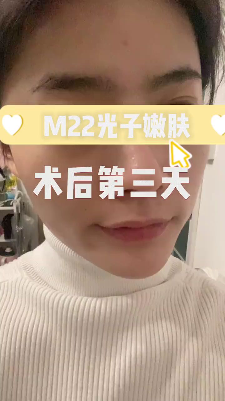 m22光子嫩膚術後第三天效果對比