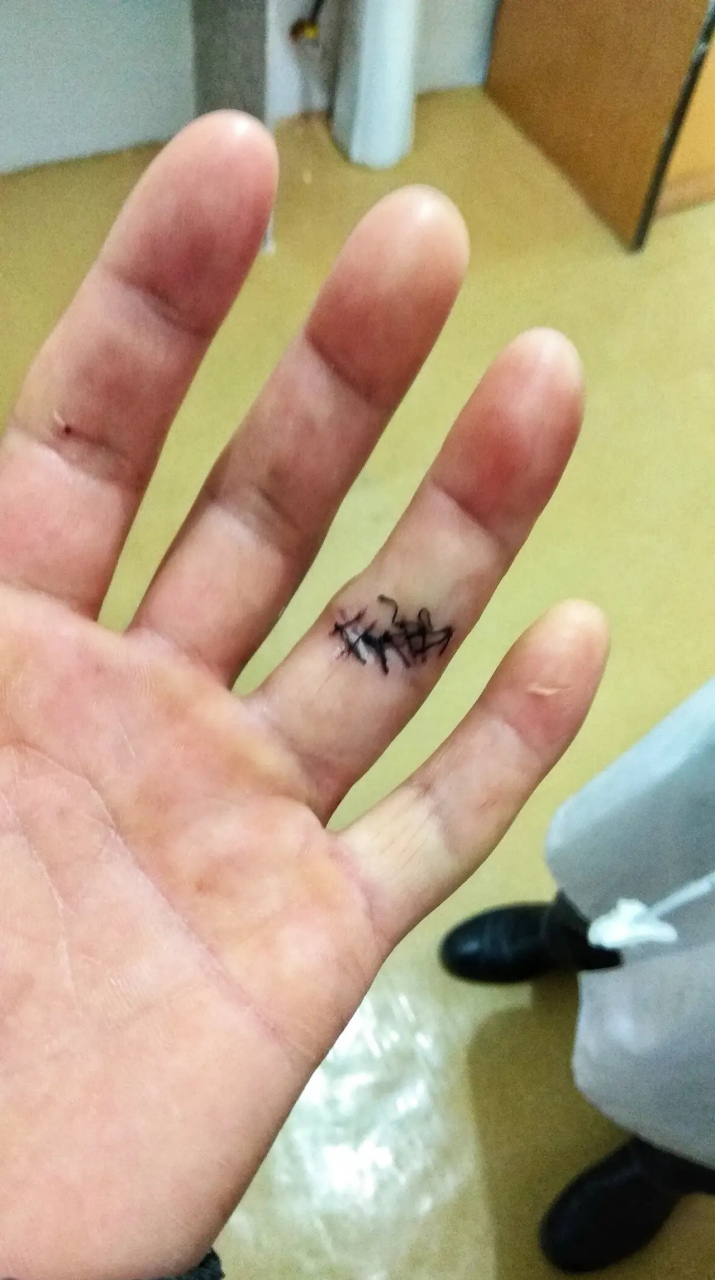 前几天不小心割到手,就一个小口子,但流血不止,去诊所 医生说这个要
