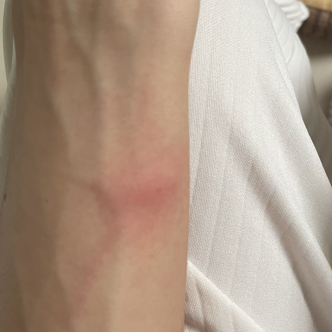 被蚊子咬到静脉炎